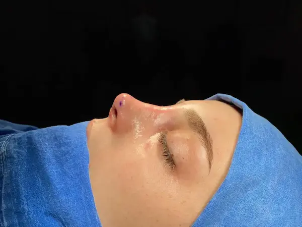 تجميل الانف اللحمي العريض تجميل الانف اللحمي العريض
