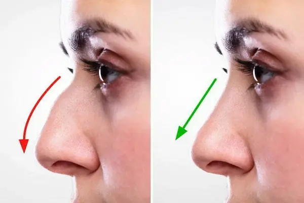 تشوهات الأنف تشوهات الأنف