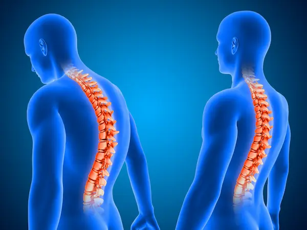 تشوهات العمود الفقري الخلقية تشوهات العمود الفقري الخلقية