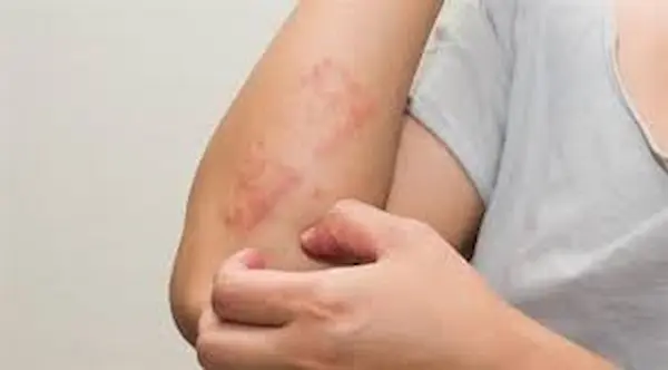 اعراض حساسية السمك