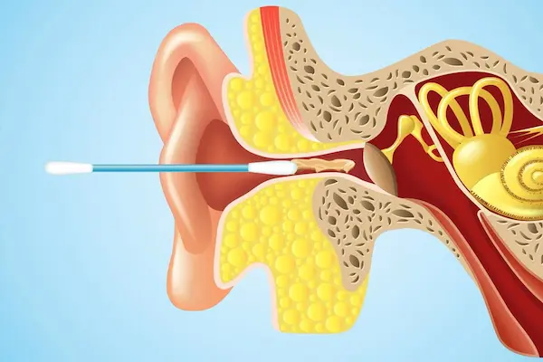 أسباب انسداد الاذن أسباب انسداد الاذن