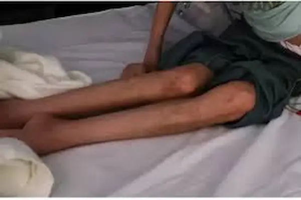 متلازمة غيلان باريه متلازمة غيلان باريه