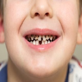 تعرف على سبب سواد اللثة عند الأطفال مع 5 طرق للعلاج تعرف على سبب سواد اللثة عند الأطفال مع 5 طرق للعلاج